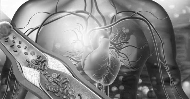 Human heart with blocked arteries. 3d illustration (Photo by Rasi Bhadramani)