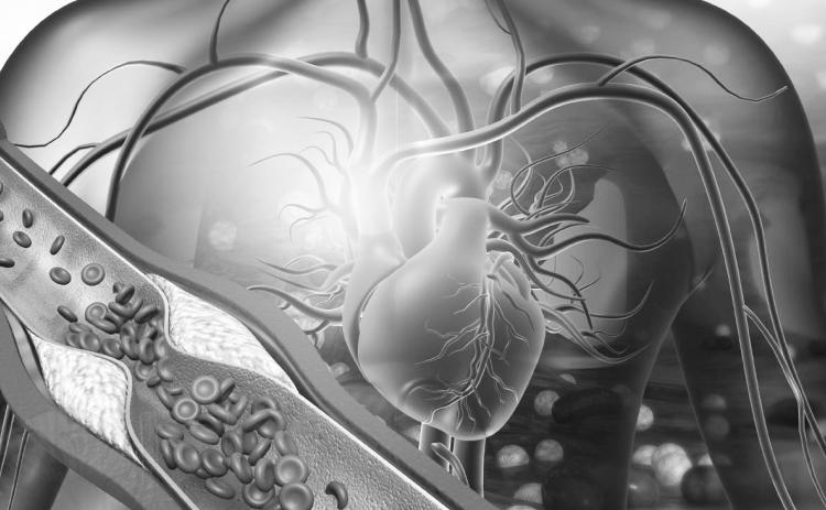 Human heart with blocked arteries. 3d illustration (Photo by Rasi Bhadramani)
